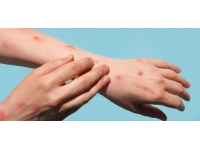 Almanya’da 2 bin 724 maymun çiçeği vakası görüldü