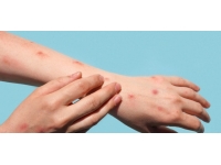 DSÖ: Afrika’da bu yıl 30 bin maymun çiçeği vakası görüldü