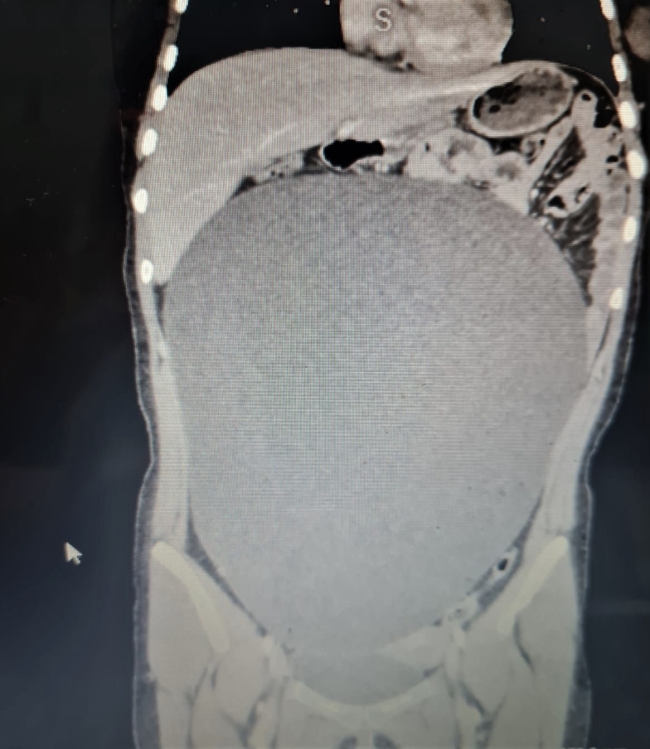 Karnındaki kitleden geçirdiği kaza sayesinde kurtuldu